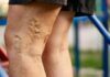 The Common Venous Stasis Dermatitis Myths That Have Been Misleading Most People Venous Stasis Dermatitis