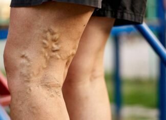 The Common Venous Stasis Dermatitis Myths That Have Been Misleading Most People Venous Stasis Dermatitis