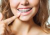 The Advantages of Invisalign Braces Braces
