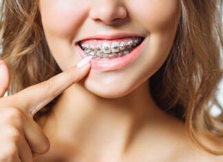 The Advantages of Invisalign Braces Braces