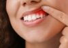 Gum Disease: 5 Ways To Make Your Treatment More Effective Gum Disease