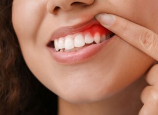 Gum Disease: 5 Ways To Make Your Treatment More Effective Gum Disease