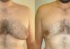 Everything You Need To Know About Male Breast Reduction Surgery Male Breast Reduction Surgery