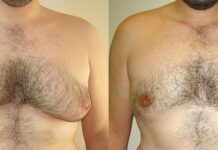 Everything You Need To Know About Male Breast Reduction Surgery Male Breast Reduction Surgery
