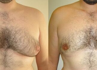 Everything You Need To Know About Male Breast Reduction Surgery Male Breast Reduction Surgery