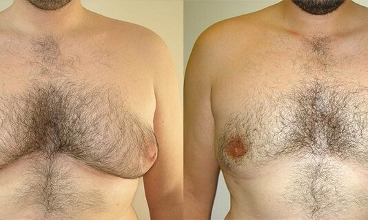 Everything You Need To Know About Male Breast Reduction Surgery Male Breast Reduction Surgery