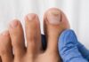 Toenail fungus- Symptoms Toenail fungus