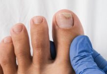 Toenail fungus- Symptoms Toenail fungus