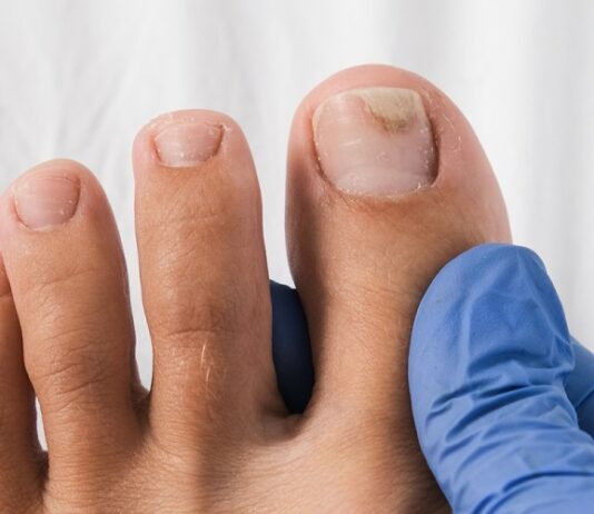 Toenail fungus- Symptoms Toenail fungus
