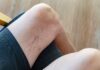 Here are the Symptoms and Treatments of Varicose Veins Varicose Veins
