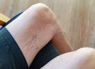 Here are the Symptoms and Treatments of Varicose Veins Varicose Veins