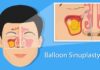 The Benefits of Balloon Sinuplasty for Chronic Sinusitis Patients Balloon Sinuplasty