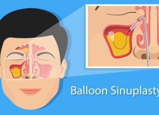 The Benefits of Balloon Sinuplasty for Chronic Sinusitis Patients Balloon Sinuplasty