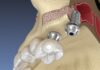Benefits of Sinus Augmentation Sinus Augmentation
